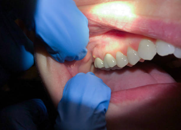 Best Lost Filling or Crown Replacement in King City, CA