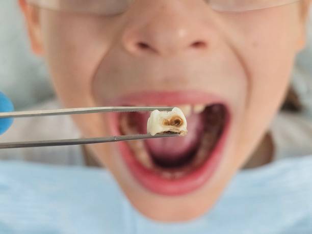 Best Knocked-Out Tooth (Avulsed Tooth) Treatment in King City, CA